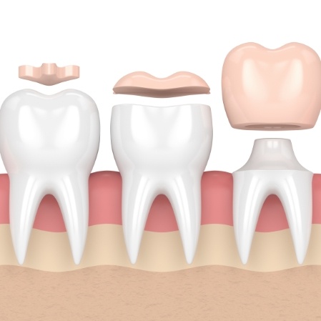 Animated teeth comparing filling onlay and dental crown restorations