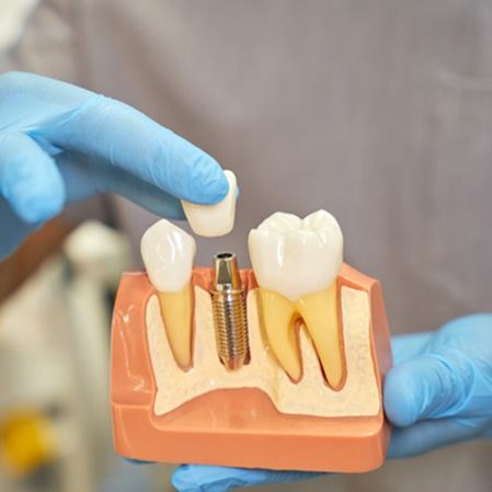 dentist placing a crown on top of a dental implant model
