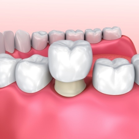 Animated smile during dental crown placement restorative dentistry treatment
