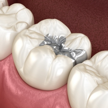 Animated smile with metal dental filling