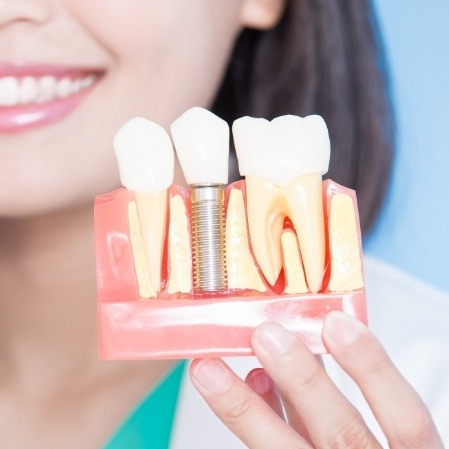 Model comparing dental implant supported dental crown with natural tooth