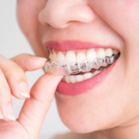 : Closeup of woman placing Invisalign aligner in mouth